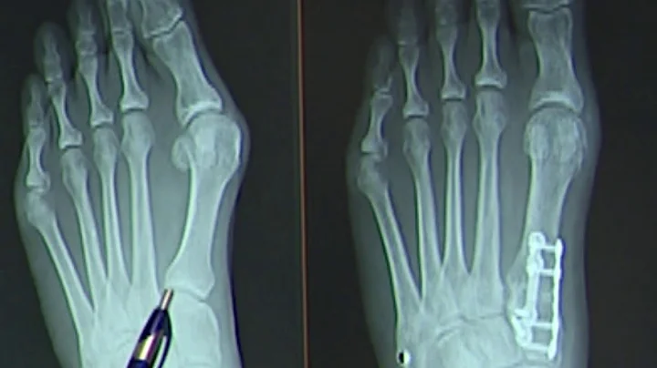 Lillie Bunion Photo 2